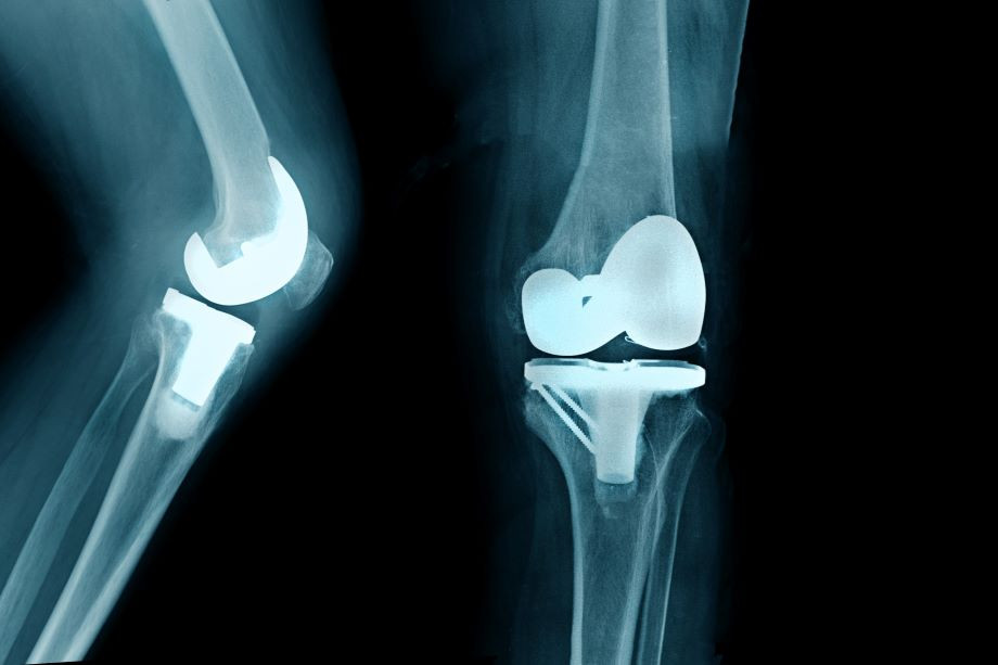 partial knee replacement