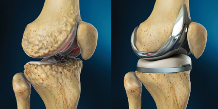 total knee arthroplasty